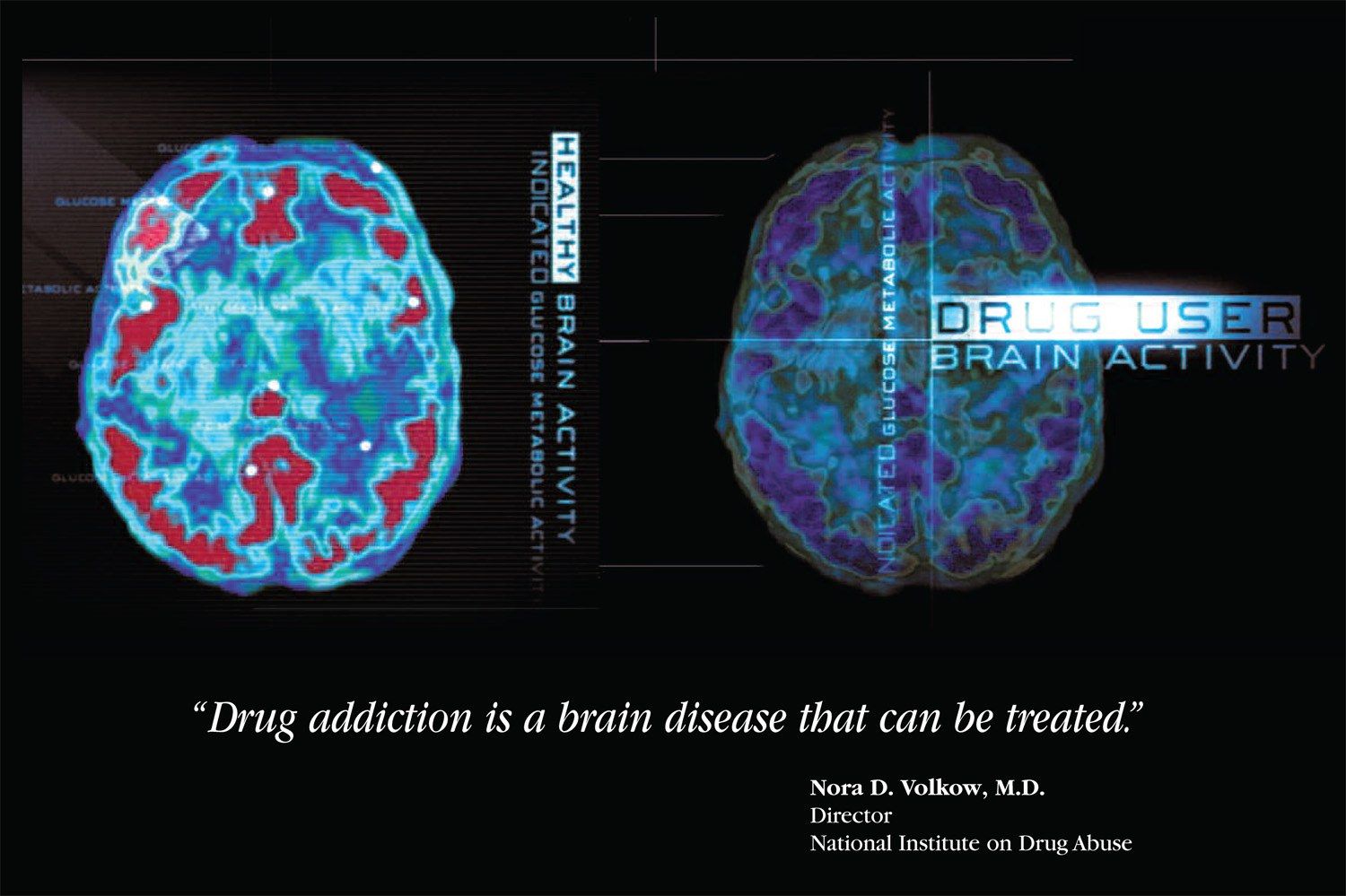The image shows a brain scan with the words "Drug Addiction is a Brain Disease that can be Treated"...