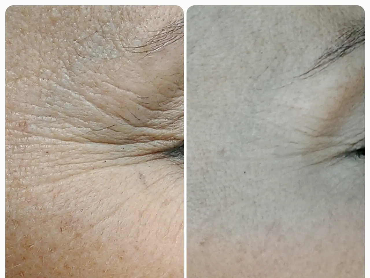 Unveiling Skin Tags: Understanding Origin, Treatment Options, and Potential Concerns