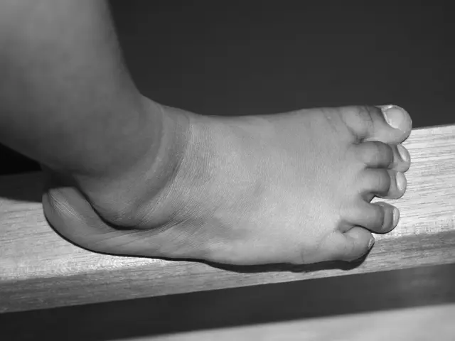 mysteries behind leg bruising: potential causes and treatment options? yes, it's treatable?