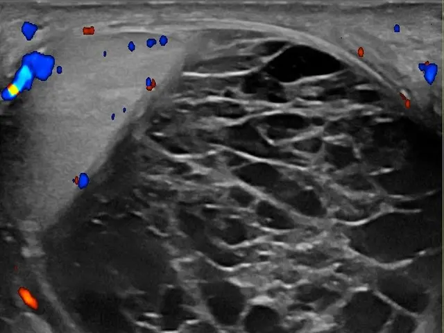 The image shows a mammogram of a patient's chest, which is a CT scan of the heart. The scan is...